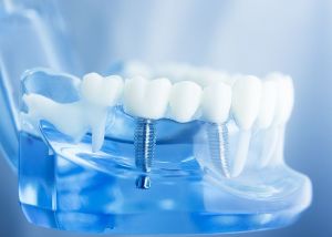 Glaze Peter M Dr - Dentists-Periodontics (Gum & Implant Surgery)