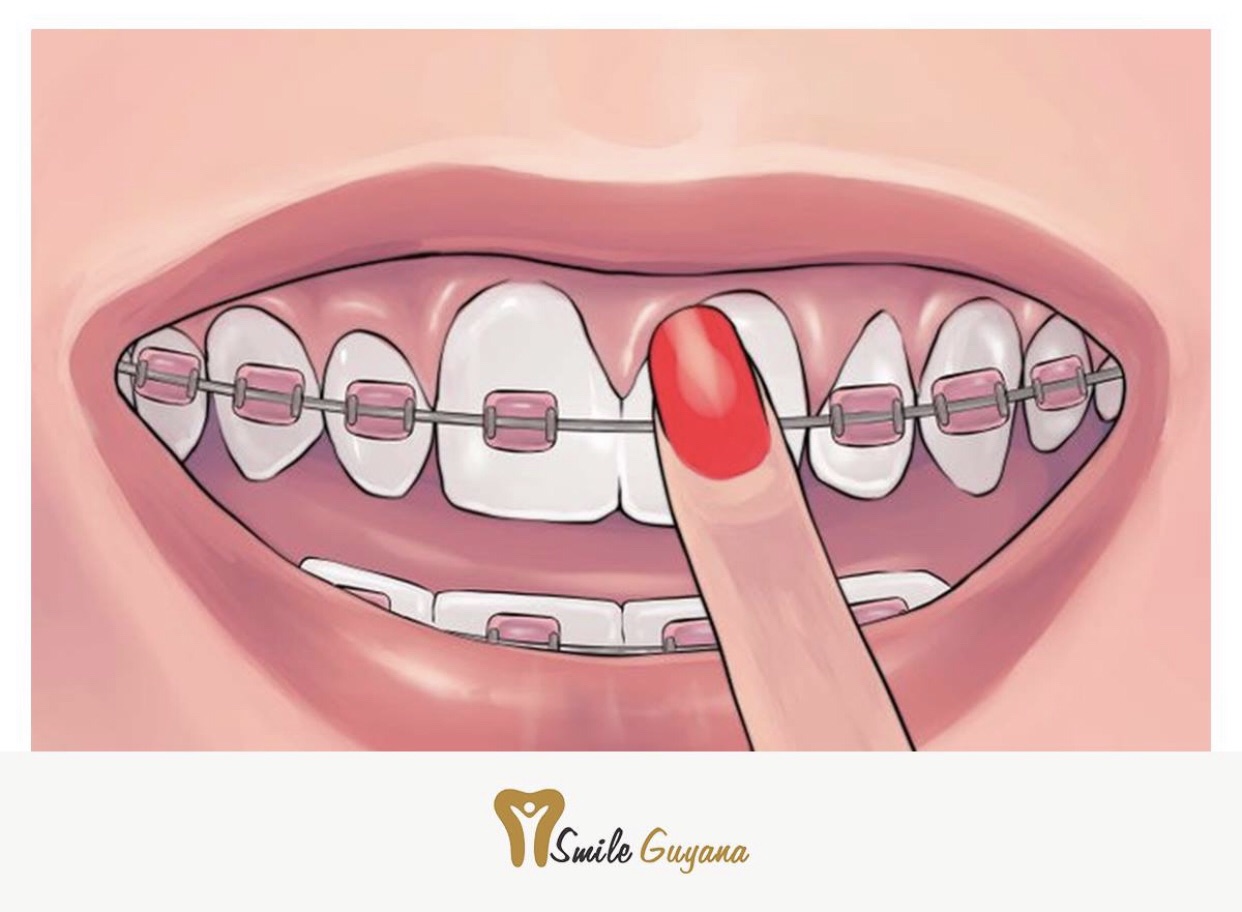 Smile Guyana Dental Services - Dental Implants-Implantology